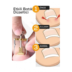 Mey İthalat® Batık Tırnak Çıkartıcı Orijinal Çelik Batan Tırnağı Düzeltme Aparatı Düzeltici Aleti Çıkarıcı Aparat