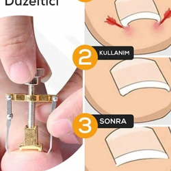 Mey İthalat® Batık Tırnak Çıkartıcı Orijinal Çelik Batan Tırnağı Düzeltme Aparatı Düzeltici Aleti Çıkarıcı Aparat